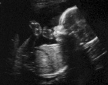 Jolie's 20-Week "Level 2" Ultrasound