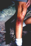 Chris Mal's Bloody Leg, 1995
